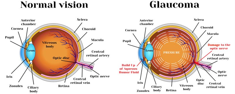 Glaucoma