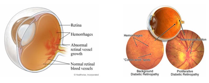 Retina